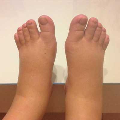 孕期无浮肿正常吗,孕期没水肿正常吗  第1张