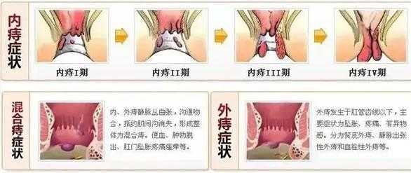 孕期长痔疮(孕期长痔疮怎么办 有肉球) 第3张 孕期长痔疮(孕期长痔疮怎么办 有肉球) 第3张
