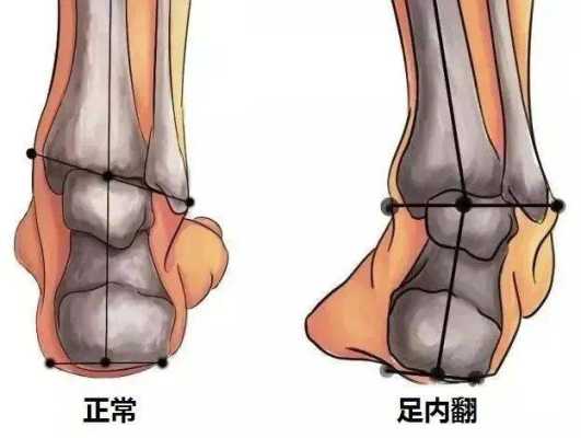 胎儿双足内翻怎么办（胎儿足内翻是脑瘫吗）  第1张