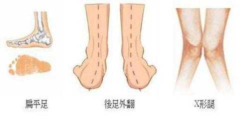 胎儿双足内翻怎么办（胎儿足内翻是脑瘫吗）  第3张