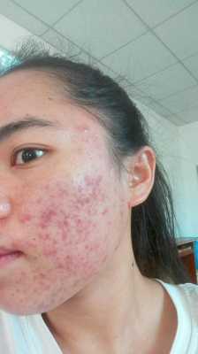 孕期挤痘痘（孕妇脸上长了很多痘痘，里面有些脓，挤掉以后可以用酒精消炎吗）  第2张