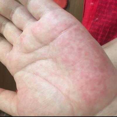 孕期手心发热(孕期手心发热是怎么回事?) 第2张 孕期手心发热(孕期手心发热是怎么回事?) 第2张