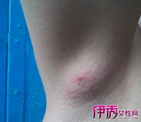 孕期腋下淋巴(孕期腋下淋巴结肿大正常吗) 第1张 孕期腋下淋巴(孕期腋下淋巴结肿大正常吗) 第1张