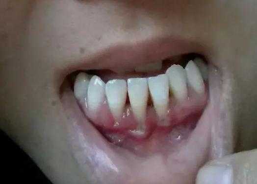 孕期牙龈萎缩（牙龈萎缩了还可以恢復吗）  第3张