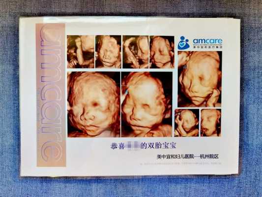 四维查出宝宝心脏畸形怎么办才好的呢,胎儿心脏外翻超声表现 第2张 四维查出宝宝心脏畸形怎么办才好的呢,胎儿心脏外翻超声表现 第2张