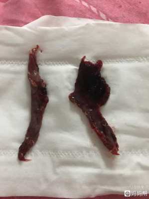 孕期流产症状(怀孕初期流产有什么症状) 第2张 孕期流产症状(怀孕初期流产有什么症状) 第2张