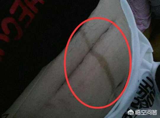 孕期妊娠线(为什么怀孕没有妊娠线啊) 第1张 孕期妊娠线(为什么怀孕没有妊娠线啊) 第1张