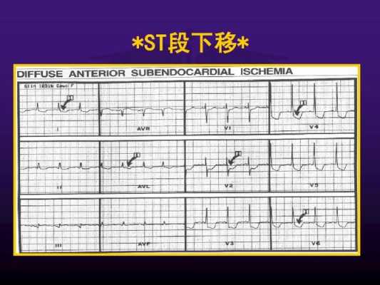 孕期窦性心律(什么是窦性心律?s-t段异常时怎么回事5) 第3张 孕期窦性心律(什么是窦性心律?s-t段异常时怎么回事5) 第3张