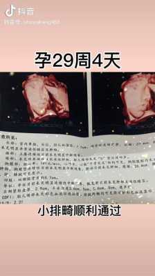 孕29周胎儿腿短怎么办?我怀孕29周,b超显示胎儿股骨长5.4,胎儿腿短5周怎么办 第1张 孕29周胎儿腿短怎么办?我怀孕29周,b超显示胎儿股骨长5.4,胎儿腿短5周怎么办 第1张