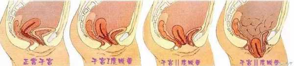 生完孩子宫颈下垂了应该怎么办,孕期宫颈下垂怎么改善 第2张 生完孩子宫颈下垂了应该怎么办,孕期宫颈下垂怎么改善 第2张