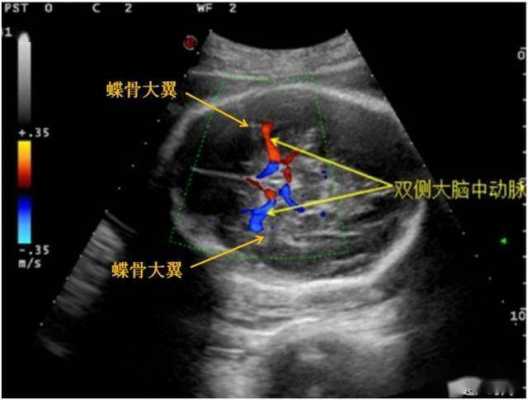 胎儿脑中线中断(排球规则扣球队员可以过中线) 第2张 胎儿脑中线中断(排球规则扣球队员可以过中线) 第2张