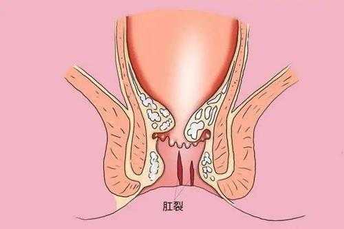 孕期肛裂出血(孕妇肛门出血怎么回事) 第3张 孕期肛裂出血(孕妇肛门出血怎么回事) 第3张