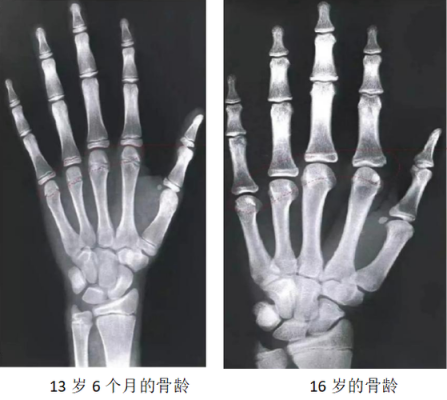 骨龄偏缓是什么意思,胎儿发育过缓原因 第3张 骨龄偏缓是什么意思,胎儿发育过缓原因 第3张