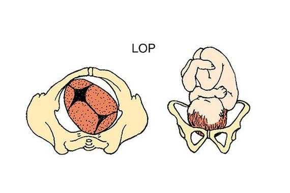 l和p哪个是左,胎儿头位lop是什么意思 第3张 l和p哪个是左,胎儿头位lop是什么意思 第3张