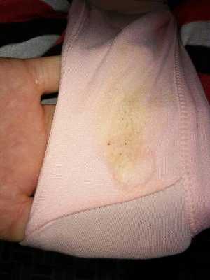 怀孕中期,乳头有裂痕是怎么回事, 第2张 怀孕中期,乳头有裂痕是怎么回事, 第2张