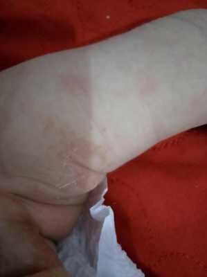 孕期臀部湿疹(小儿屁股湿疹) 第3张 孕期臀部湿疹(小儿屁股湿疹) 第3张
