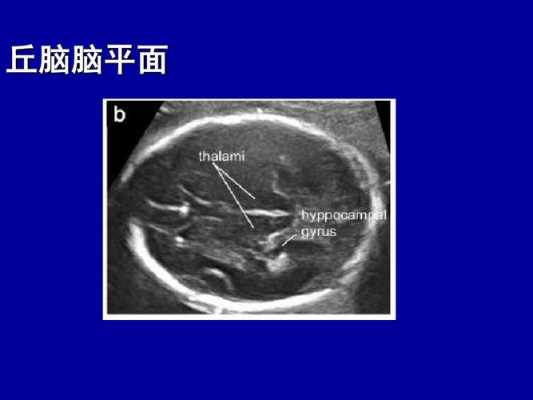 胎儿丘脑是什么(胎儿四维中间帆腔,为什么,严重么) 第1张 胎儿丘脑是什么(胎儿四维中间帆腔,为什么,严重么) 第1张