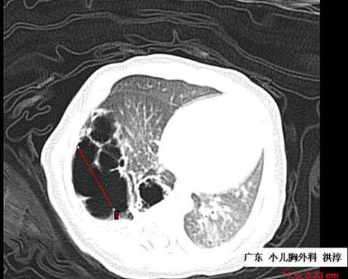 胎儿右肺囊腺瘤(先天性肺囊腺瘤会变小吗) 第1张 胎儿右肺囊腺瘤(先天性肺囊腺瘤会变小吗) 第1张