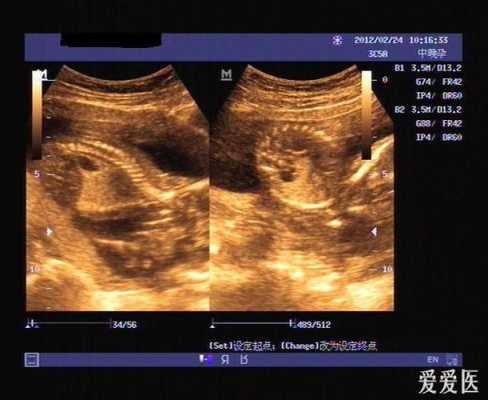 胎儿右肺囊腺瘤(先天性肺囊腺瘤会变小吗) 第2张 胎儿右肺囊腺瘤(先天性肺囊腺瘤会变小吗) 第2张