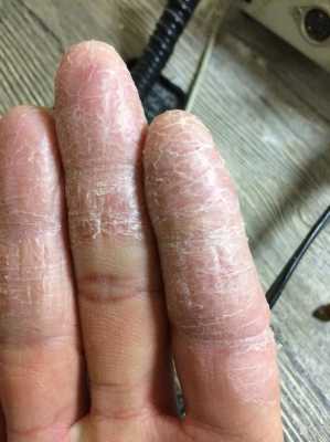 孕期手脱皮(孕期手脱皮是什么原因导致的) 第2张 孕期手脱皮(孕期手脱皮是什么原因导致的) 第2张