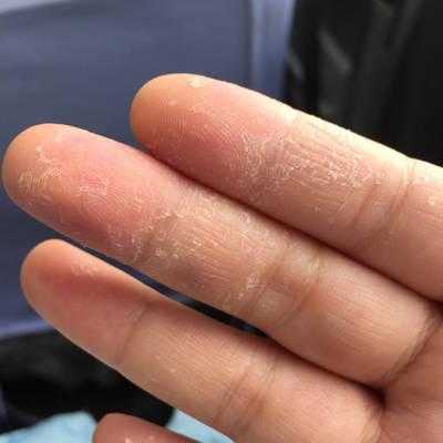 孕期手脱皮(孕期手脱皮是什么原因导致的) 第1张 孕期手脱皮(孕期手脱皮是什么原因导致的) 第1张