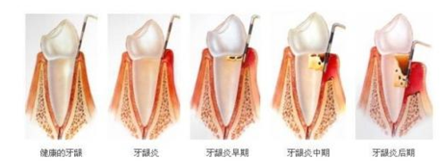 牙周炎会影响胎儿吗(牙周炎会影响胎儿吗) 第2张 牙周炎会影响胎儿吗(牙周炎会影响胎儿吗) 第2张