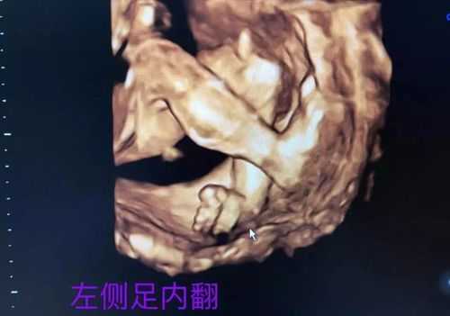 担心胎儿脸上有胎记(四维彩超能不能看出胎儿脸上是否有胎记) 第2张 担心胎儿脸上有胎记(四维彩超能不能看出胎儿脸上是否有胎记) 第2张