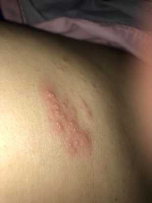 孕妇肚子上长湿疹怎么办,孕期肚子湿疹可以用金银花水擦吗 第2张 孕妇肚子上长湿疹怎么办,孕期肚子湿疹可以用金银花水擦吗 第2张