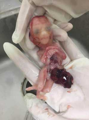 胎儿坏死有什么症状(胎儿坏死有什么症状吗) 第1张 胎儿坏死有什么症状(胎儿坏死有什么症状吗) 第1张