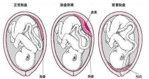 胎盘位于子宫底及后壁,成熟度2级是什么意思,胎儿位于子宫后壁什么意思 第2张 胎盘位于子宫底及后壁,成熟度2级是什么意思,胎儿位于子宫后壁什么意思 第2张