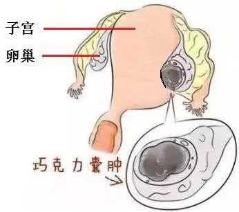 孕期囊肿增大(孕期囊肿增大肚子是不是也特别显怀?) 第1张 孕期囊肿增大(孕期囊肿增大肚子是不是也特别显怀?) 第1张