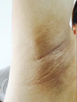 怀孕腋下变黑是怎么回事,孕期腋窝发黑是男孩还是女孩 第1张 怀孕腋下变黑是怎么回事,孕期腋窝发黑是男孩还是女孩 第1张