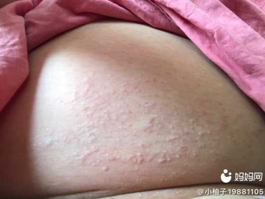 孕期腹部痒（孕期腹部痒怎么回事）  第3张
