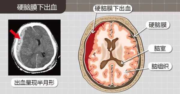 胎儿脑颅出血能要吗(胎儿脑出血还能要吗) 第2张 胎儿脑颅出血能要吗(胎儿脑出血还能要吗) 第2张