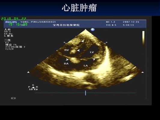如何促进胎儿心脏发育(孕检心脏彩超能查出什么) 第2张 如何促进胎儿心脏发育(孕检心脏彩超能查出什么) 第2张