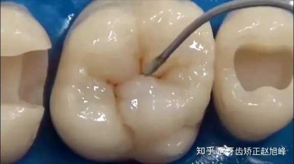 孕期蛀牙掉了(孕期蛀牙掉了一半,可以填补吗) 第2张 孕期蛀牙掉了(孕期蛀牙掉了一半,可以填补吗) 第2张