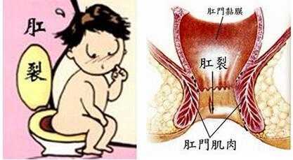 孕期便秘肛裂(孕期便秘肛裂怎么办) 第2张 孕期便秘肛裂(孕期便秘肛裂怎么办) 第2张