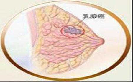 孕期乳房肿块(孕期乳房肿块变大变硬) 第3张 孕期乳房肿块(孕期乳房肿块变大变硬) 第3张