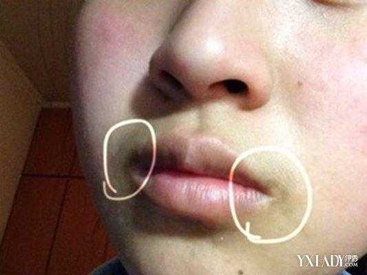 孕期嘴角发黑(【嘴角发黑去掉方法有哪些】) 第3张 孕期嘴角发黑(【嘴角发黑去掉方法有哪些】) 第3张