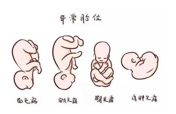 胎儿为什么胎位不正(胎儿为什么胎位不正呢) 第2张 胎儿为什么胎位不正(胎儿为什么胎位不正呢) 第2张