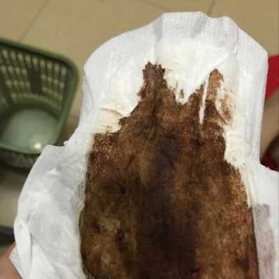 怀孕初期老流褐色血怎么办,孕期流血褐色怎么回事 第2张 怀孕初期老流褐色血怎么办,孕期流血褐色怎么回事 第2张