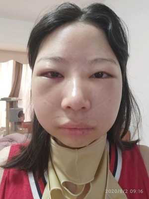 眼睛浮肿是什么原因?吃什么药才好呢,孕期眼睛浮肿是什么原因 第1张 眼睛浮肿是什么原因?吃什么药才好呢,孕期眼睛浮肿是什么原因 第1张