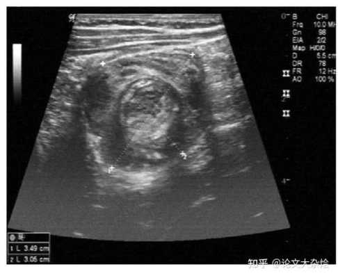 胎儿肠道回声稍增强(胎儿肠道回声稍增强严重吗) 第2张 胎儿肠道回声稍增强(胎儿肠道回声稍增强严重吗) 第2张