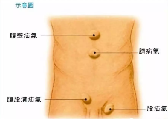 孕期腹股沟疝(儿童腹股沟疝气) 第3张 孕期腹股沟疝(儿童腹股沟疝气) 第3张