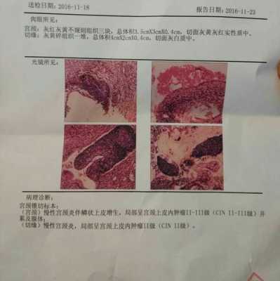 孕期宫颈增生(宫颈鳞状上皮增生怎么治疗) 第1张 孕期宫颈增生(宫颈鳞状上皮增生怎么治疗) 第1张