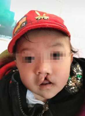 胎儿兔唇怎么办（胎儿兔唇是什么原因造成的）  第2张