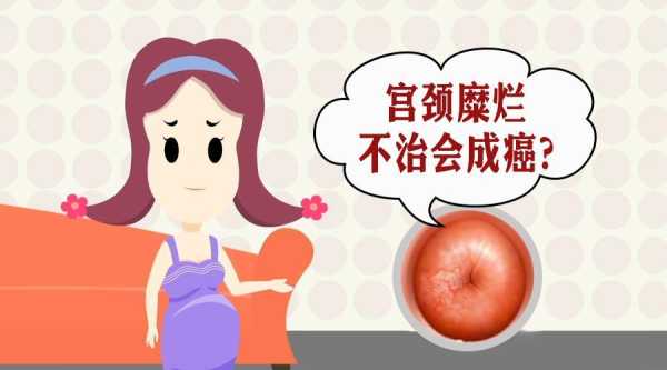 宫颈糜烂孕期(子宫颈糜烂怎么治疗) 第3张 宫颈糜烂孕期(子宫颈糜烂怎么治疗) 第3张
