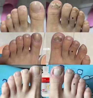 孕期灰指甲(孕期灰指甲怎么治疗最好) 第1张 孕期灰指甲(孕期灰指甲怎么治疗最好) 第1张
