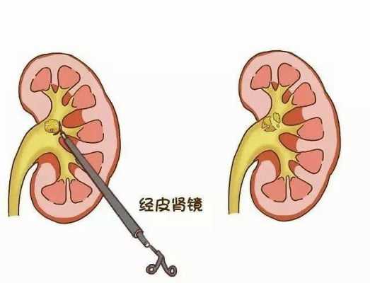孕期尿路结石(孕期尿路结石怎么办) 第2张 孕期尿路结石(孕期尿路结石怎么办) 第2张