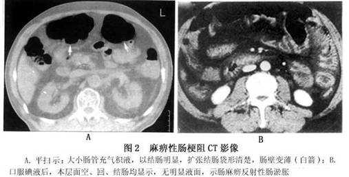 胎儿肠道积液的原因(胎儿肠道积液的原因有哪些) 第3张 胎儿肠道积液的原因(胎儿肠道积液的原因有哪些) 第3张